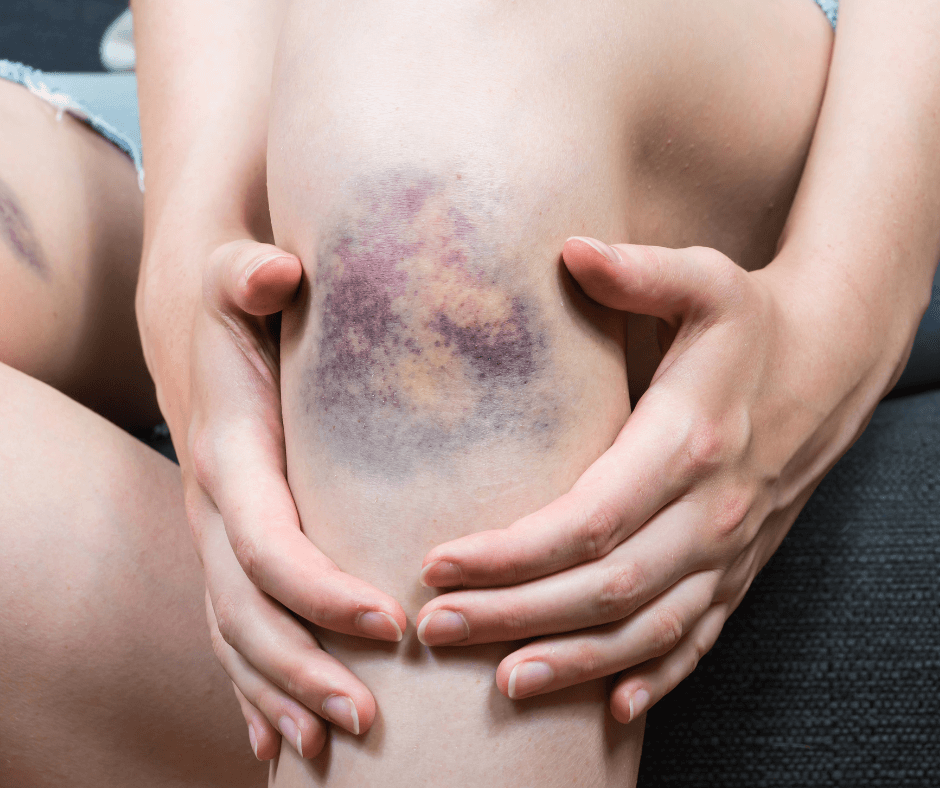 eine Frau hält ihr blaues Knie